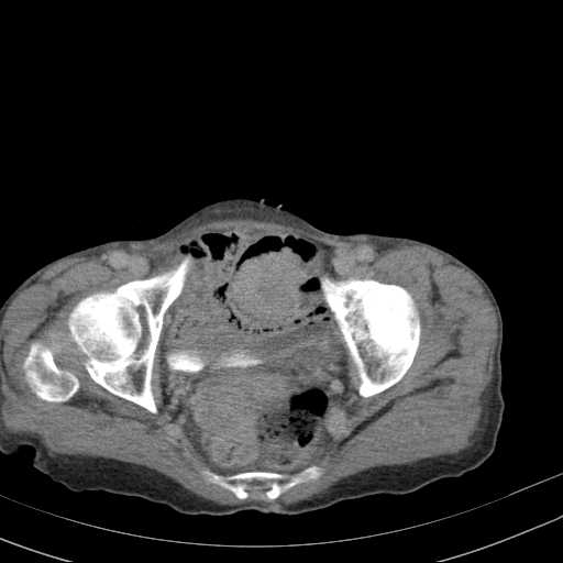 File:Abdominal aortic aneurysm (Radiopaedia 20827-20742 Axial C+ delayed 34).jpg