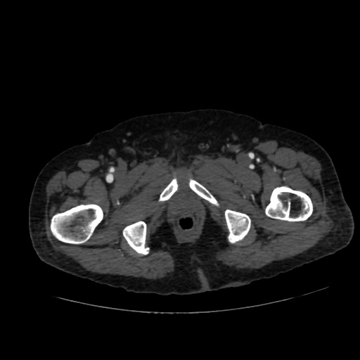 File:Abdominal aortic aneurysm (Radiopaedia 57318-64259 Axial C+ arterial phase 81).jpg