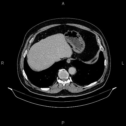 File:Abdominal aortic aneurysm (Radiopaedia 83094-97462 Axial renal excretory phase 18).jpg
