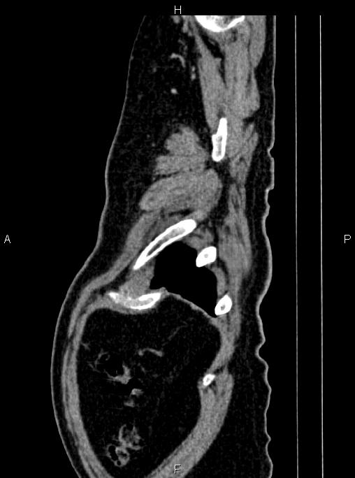 Abdominal aortic aneurysm (Radiopaedia 83094-97462 Sagittal renal cortical phase 117).jpg