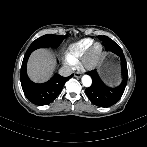 Abdominal aortic aneurysm (Radiopaedia 83581-98689 Axial C+ arterial phase 13).jpg