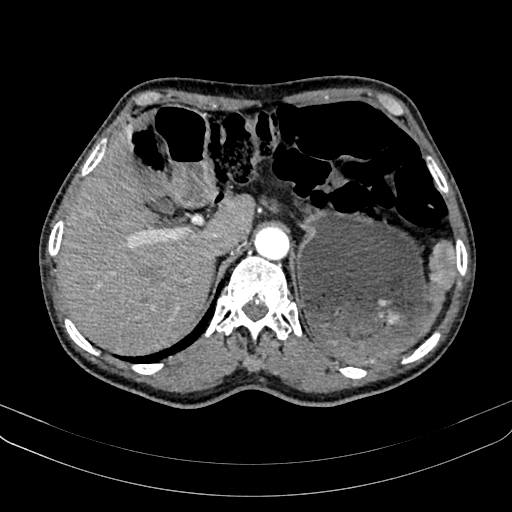 Abdominal aortic aneurysm (Radiopaedia 83581-98689 Axial C+ arterial phase 32).jpg