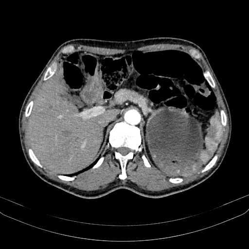 Abdominal aortic aneurysm (Radiopaedia 83581-98689 Axial C+ arterial phase 34).jpg