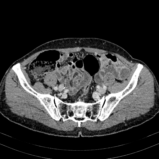 Abdominal aortic aneurysm (Radiopaedia 83581-98689 Axial C+ portal venous phase 87).jpg