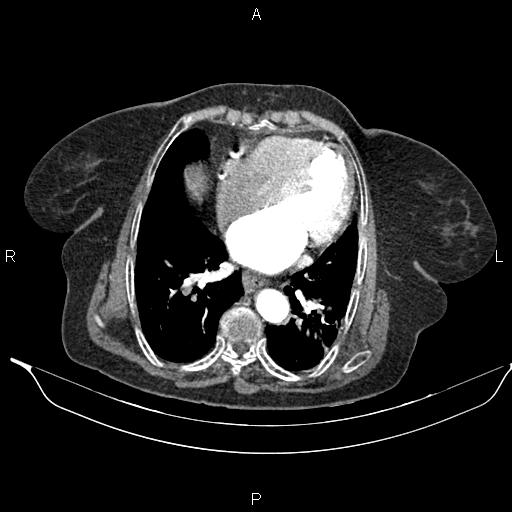 File:Abdominal aortic aneurysm (Radiopaedia 85063-100606 Axial C+ arterial phase 22).jpg