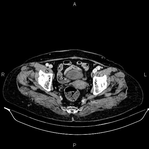 File:Abdominal aortic aneurysm (Radiopaedia 85063-100606 Axial C+ portal venous phase 61).jpg