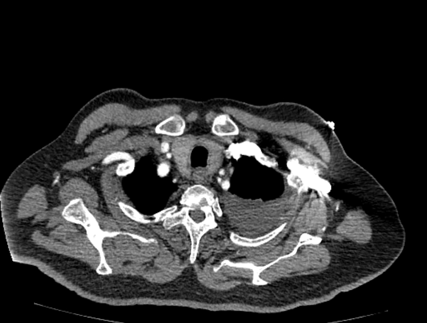 Abdominal aortic aneurysm rupture (Radiopaedia 54179-60362 Axial C+ arterial phase 1).jpg