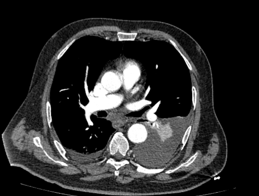 Abdominal aortic aneurysm rupture (Radiopaedia 54179-60362 Axial C+ arterial phase 10).jpg