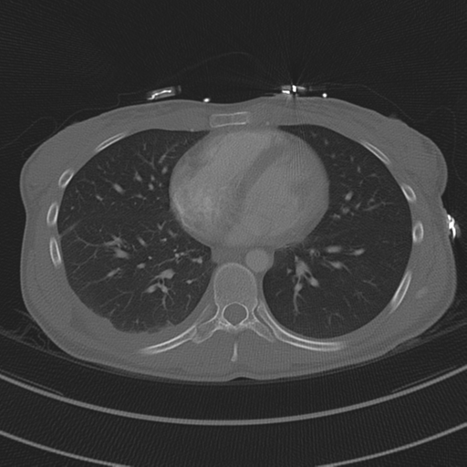 File:Abdominal multi-trauma - devascularised kidney and liver, spleen and pancreatic lacerations (Radiopaedia 34984-36486 I 55).png