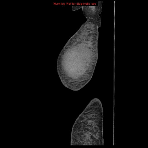 Abdominal wall hematoma (Radiopaedia 9427-10112 Sagittal C+ portal venous phase 111).jpg