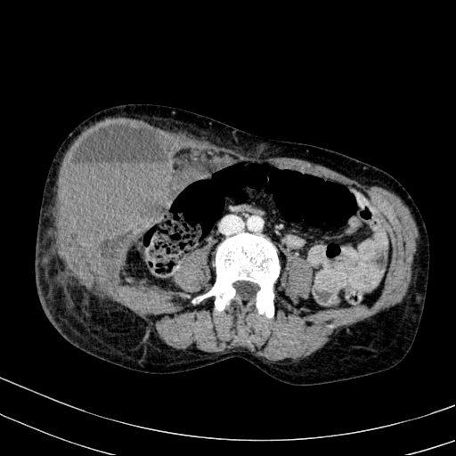 Abdominal wall hematoma with active bleeding (Radiopaedia 83915-99122 Axial contrast-enhanced CT 33).jpg