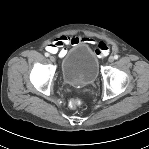 File:Abdominal wall metastasis from colorectal carcinoma (Radiopaedia 31016-31717 Axial C+ portal venous phase 69).jpg