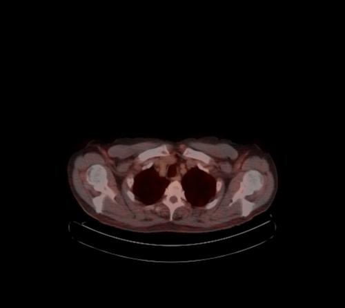 File:Abdominal wall metastasis from colorectal carcinoma (Radiopaedia 31016-31719 C 124).jpg