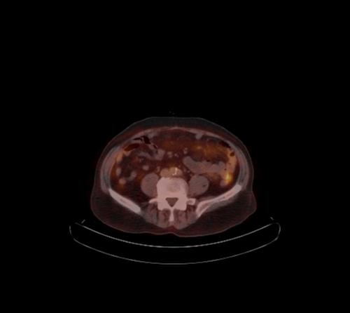 Abdominal wall metastasis from colorectal carcinoma (Radiopaedia 31016-31719 C 51).jpg