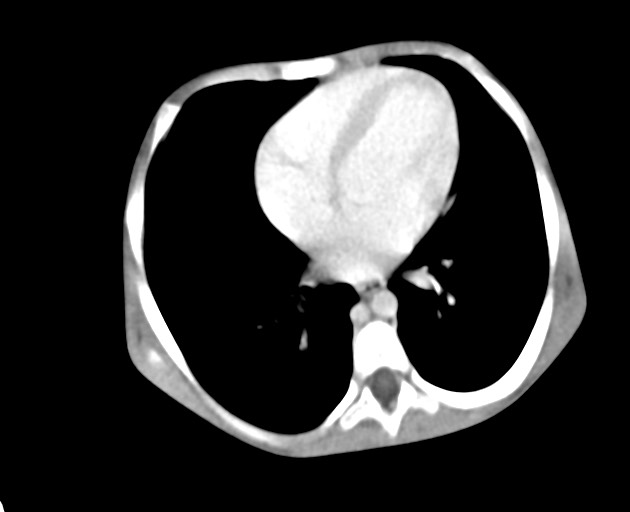 Abdominopelvic rhabdomyosarcoma (Radiopaedia 78356-90984 Axial C+ portal venous phase 29).jpg