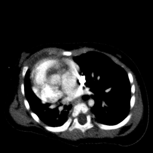 File:Aberrant left pulmonary artery (pulmonary sling) (Radiopaedia 42323-45435 Axial C+ CTPA 26).jpg