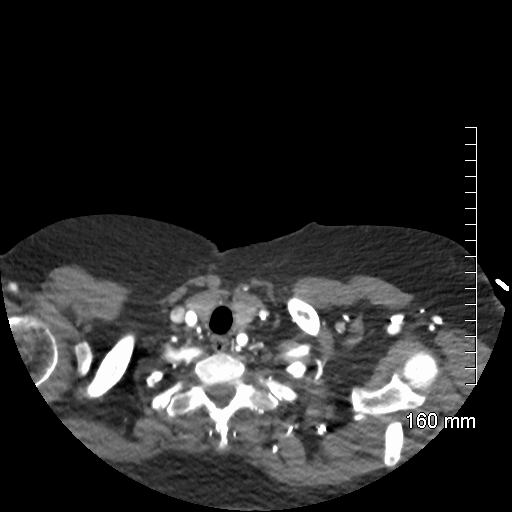 Aberrant right subclavian artery stenosis (Radiopaedia 52656-58670 Axial C+ arterial phase 4).jpg