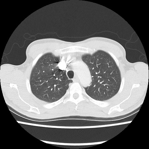 Accessory left horizontal fissure with lingular pneumonia (Radiopaedia 53763-59843 Axial lung window 16).jpg