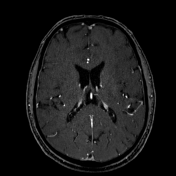 Accessory middle cerebral artery (Radiopaedia 73114-83828 Axial MRA 124).jpg