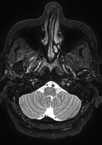 File:Accessory middle cerebral artery (Radiopaedia 73114-83828 Axial T2 199).jpg