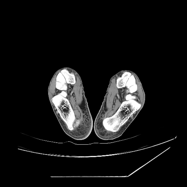 Accessory soleus muscle (Radiopaedia 61069-68943 Axial non-contrast 69).jpg