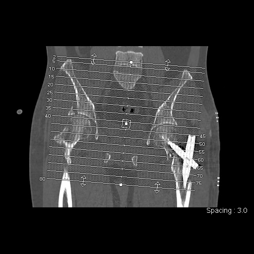 File:Acetabular and ilial fractures (Radiopaedia 59084-66378 Axial bone window 1).jpg