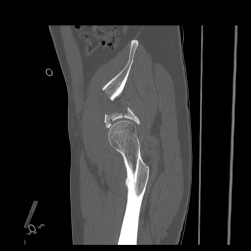 File:Acetabular and ilial fractures (Radiopaedia 59084-66378 Sagittal bone window 19).jpg