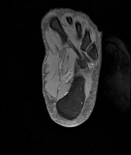 File:Achilles tendon tear (Radiopaedia 77615-89819 Axial PD fat sat 27).jpg