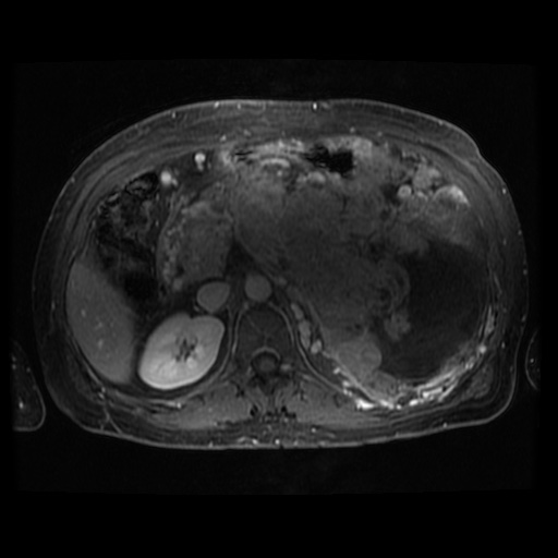 Acinar cell carcinoma of the pancreas (Radiopaedia 75442-86668 Axial T1 C+ fat sat 62).jpg
