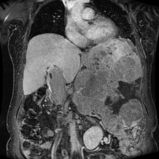 File:Acinar cell carcinoma of the pancreas (Radiopaedia 75442-86668 Coronal T1 C+ fat sat 111).jpg