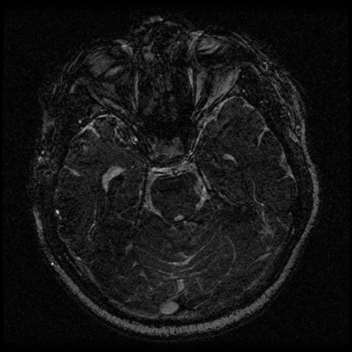 File:Acoustic schwannoma (Radiopaedia 33045-34060 Axial T2 67).png