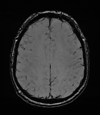 File:Acoustic schwannoma (Radiopaedia 50846-56358 Axial SWI 66).png