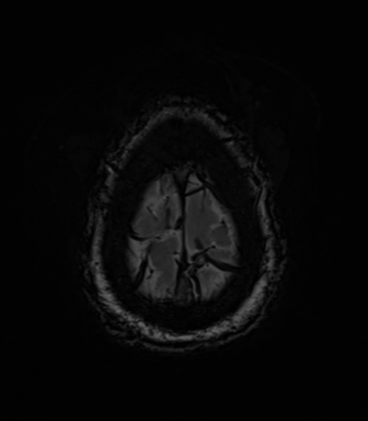 File:Acoustic schwannoma (Radiopaedia 50846-56358 Axial SWI 88).png