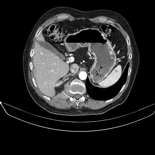 File:Acquired adrenal hyperplasia - due to thymic carcinoid tumor (Radiopaedia 21269-21184 C+ arterial phase 23).jpg