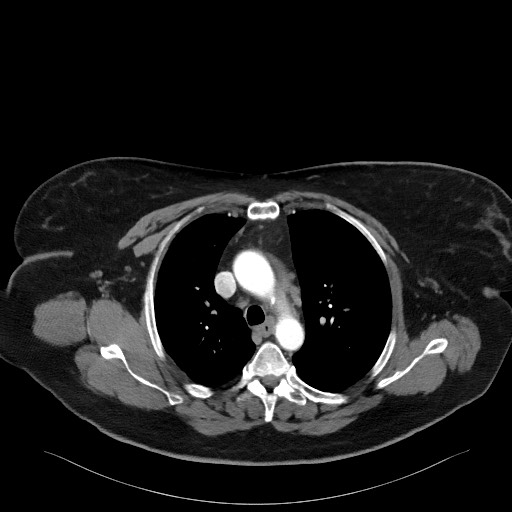 Acromioclavicular joint cyst (Radiopaedia 58455-65610 Axial C+ arterial phase 43).jpg