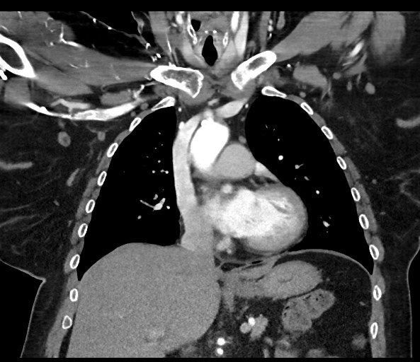 Acromioclavicular joint cyst (Radiopaedia 58455-65610 Coronal C+ arterial phase 69).jpg