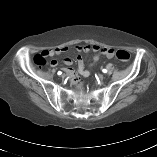File:Active bleeding from duodenal ulcer with embolization (Radiopaedia 34216-35481 Axial C+ arterial phase 49).png