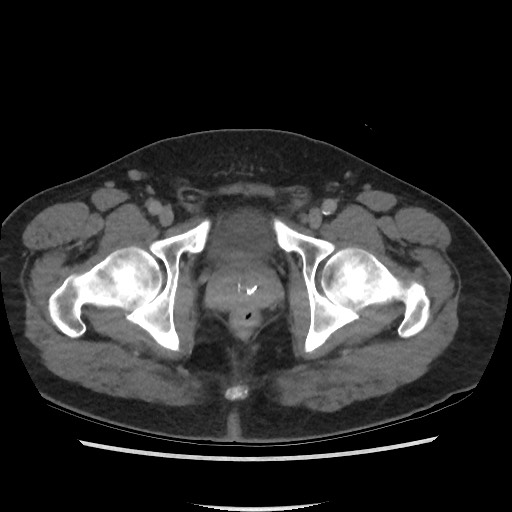 File:Active colonic bleed on CT (Radiopaedia 49765-55025 Axial C+ delayed 81).jpg