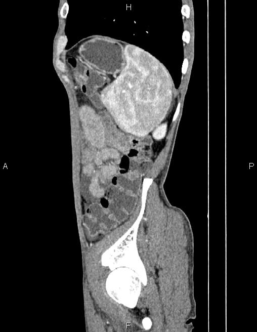 Active crohn disease (Radiopaedia 87133-103397 Sagittal C+ arterial phase 75).jpg