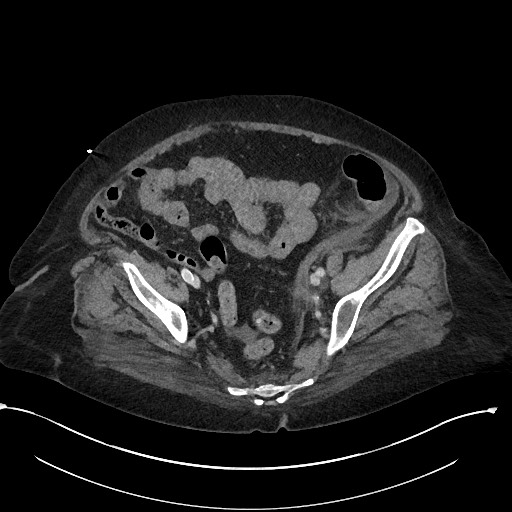 File:Active renal extravasation with large subcapsular and retroperitoneal hemorrhage (Radiopaedia 60975-68796 Axial 282).jpg