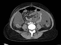 Acute Budd-Chiari syndrome (Radiopaedia 60858-68638 A 192).jpg