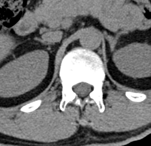 File:Acute L1 burst compression fracture (Radiopaedia 34430-35755 Axial non-contrast 8).png
