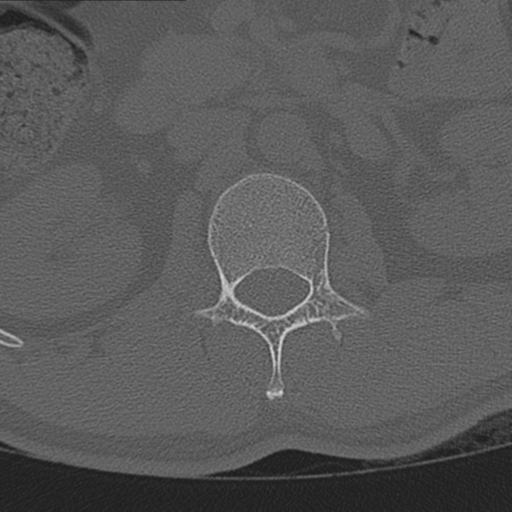 Acute L1 burst compression fracture (Radiopaedia 34430-35755 Sagittal bone window 1).png