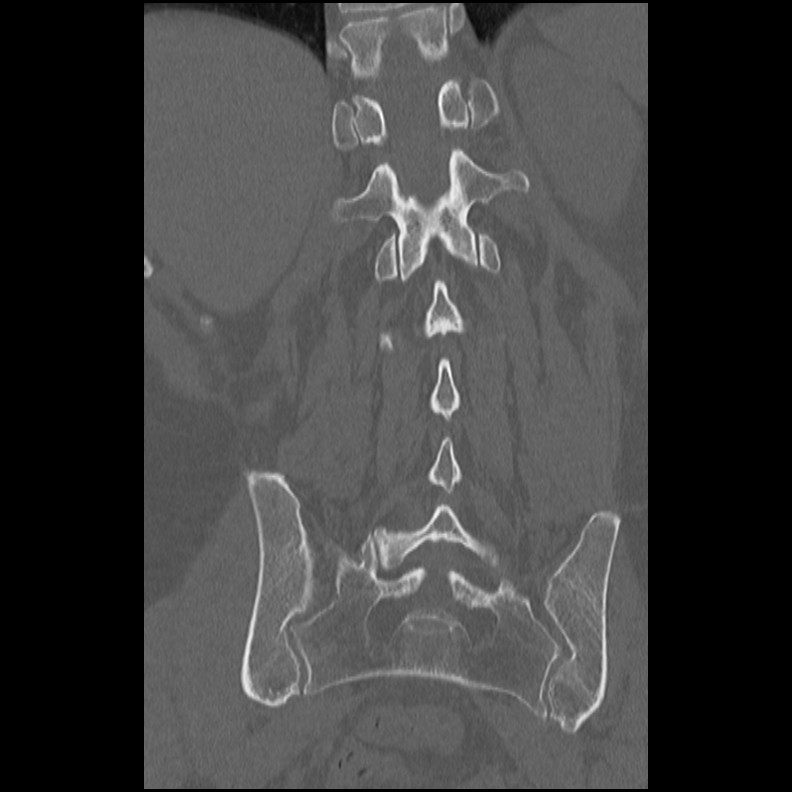 Acute Schmorl's node (Radiopaedia 83276-102365 Coronal bone window 41).jpg