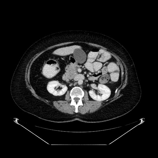 File:Acute appendicitis, heterotaxy syndrome (Radiopaedia 66884-76202 Axial 51).jpg