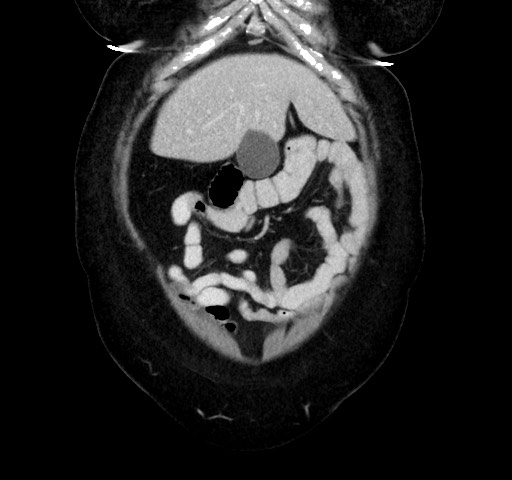 Acute appendicitis, heterotaxy syndrome (Radiopaedia 66884-76202 Coronal C+ portal venous phase 22).jpg