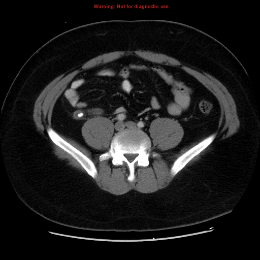 File:Acute appendicitis (Radiopaedia 12326-12607 Axial C+ portal venous phase 22).jpg