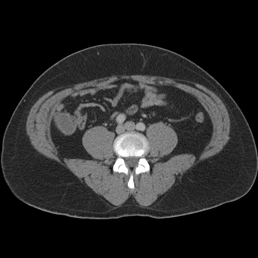 Acute appendicitis (Radiopaedia 48511-53463 Axial C+ portal venous phase 66).jpg