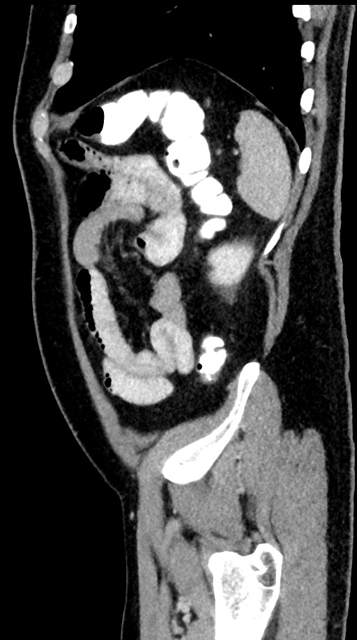 Acute appendicitis (Radiopaedia 77016-88960 Sagittal C+ portal venous phase 22).jpg