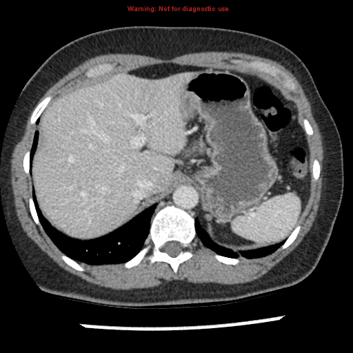 Acute appendicitis (Radiopaedia 7966-8812 C+ portal venous phase 3).jpg